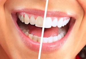 What Causes Tooth Discoloration?