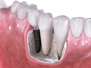 Missing teeth? Try dental implants!