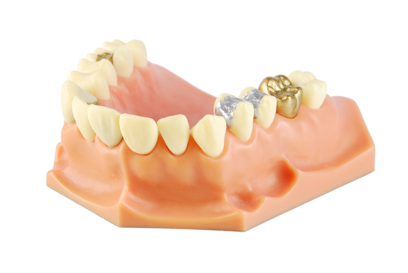 Porcelain is worth more than silver when it comes to your smile!