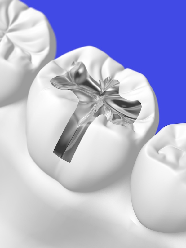 Old fillings causing damage? We can help!